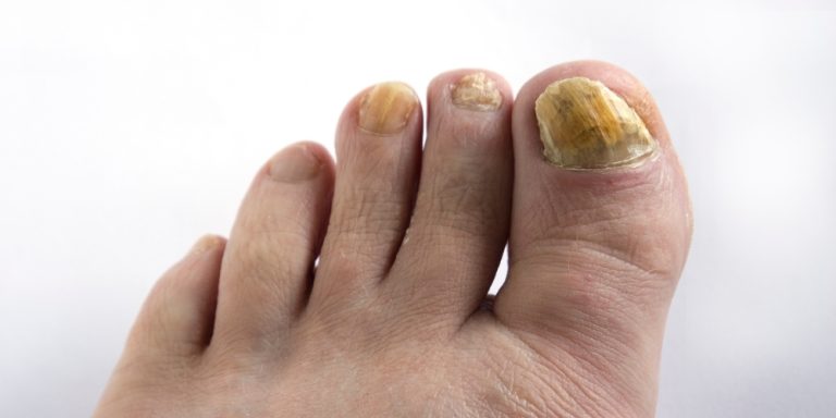 Fungal Nail Infection
